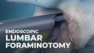 What is Endoscopic Lumbar Foraminotomy  Atlantic Spine Center [upl. by Koy]