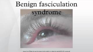 Benign fasciculation syndrome [upl. by Aroon]