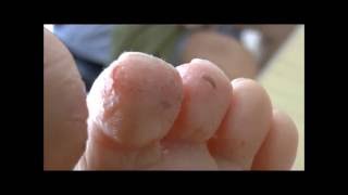 severe case of Athletes Foot before and 6 days after starting treatment [upl. by Luanne193]