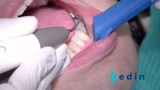 Ultrasoon reinigen bij parodontitis  Edin Dental Academy [upl. by Ennaegroeg]