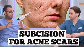 Subcision Acne Scars  Minor Surgery For Acne Scarring  Dr Somji amp Dr Solomon Explain Acne Scars [upl. by Tdnerb]