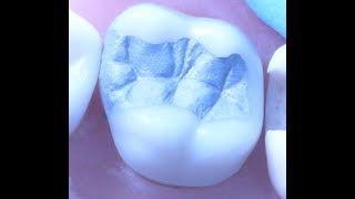 Class II Amalgam Restoration 1  Operative Dentistry [upl. by Buskus474]