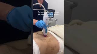 Skin tightening with Thermage thermage collagen skincare [upl. by Bazil]