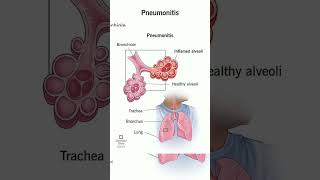 Pneumonitis shorts [upl. by Atisor]