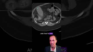 Cholecystitis on abdominal CT radiology medicalstudent radiologist radiographer [upl. by Indira]