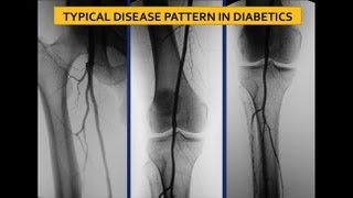 UCSF Vascular Surgery Symposium  Screening for Ischemia in the Diabetic Foot [upl. by Arehs]