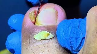 Super Huge Ingrown Toenail Removal [upl. by Keri241]