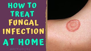 HOW TO TREAT SKIN FUNGAL INFECTION INFECTION AT HOME TINEA RINGWORM REMEDIES HOW TO CURE [upl. by Manus310]