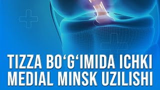 Tizza bo’g’imida ichki medial menisk uzilishi [upl. by Llertnek]