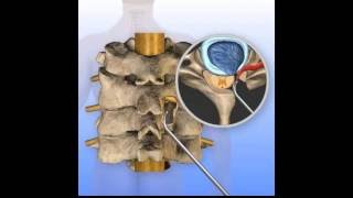 Posterior Cervical Foraminotomy Surgery Animation [upl. by Ydnat]