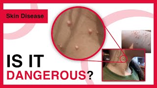 Molluscum contagiosum  Symptoms Risk factors Treatment Prevention  Dermatology [upl. by Mendes]