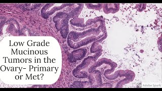 Digital Surgical Pathology 392 Mucinous ovarian tumor Primary or Met [upl. by Hildie]