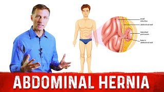 What Causes An Abdominal Hernia – DrBerg on Hernia Causes [upl. by Annovad270]