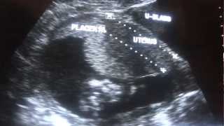 ULTRASOUND 2nd Trimester normal pregnancy [upl. by Santini720]