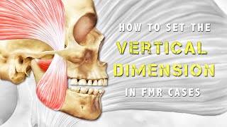 How to determine the VD in an FMR case Verticaldimension FMR VDO [upl. by Llerihs436]