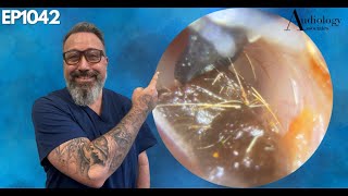 We Removed Ear Wax From a Tinnitus Patient  EP1042 [upl. by Jerusalem457]