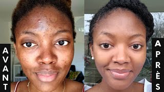 L ACNÉ COMMENT s en DÉBARRASSER 3 PRODUITS contre les boutons et les tâches🔥  SKINCARE ROUTINE💦 [upl. by Allecnirp442]