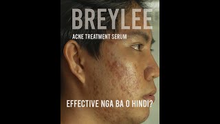 Breylee Acne Treatment Serum  Update after 1 month Effective nga ba [upl. by Idnahk]