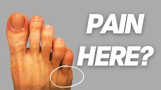 How to Fix a Tailors Bunion Bunionette [upl. by Lanette]