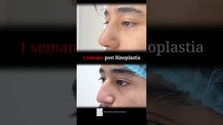 1 mes post Rinoplastia elsalvador cirujanoplástico cirugiaplasticafacial [upl. by Urba]