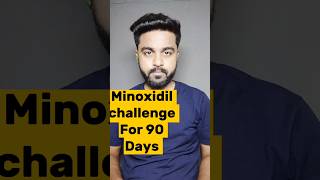 Minoxidil Challenge For 90 Days Day34  minoxidilresult minoxidil viralreels viralshorts hair [upl. by Nomolas553]