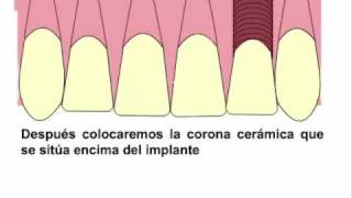 Agenesia dental Ortodoncia y sustitución con implan [upl. by Nrevel]