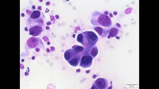 Adenocarcinoma in lungmediastinum on cytology [upl. by Sinylg]