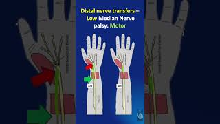 Shorts  124 Distal nerve transfers for Low Median Nerve palsy  For Motor and Sensory restoration [upl. by Torp]