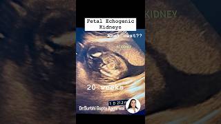 Fetal echogenic kidneys  Dr Surbhi Gupta Aggarwal  Consultant Radiologist [upl. by Turpin]