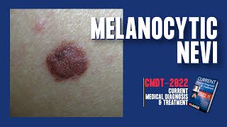 Melanocytic Nevi Normal Moles  PIGMENTED LESIONS  CMDT 2022 [upl. by Pavlov14]