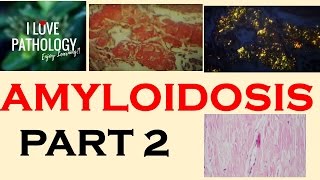 AMYLOIDOSIS PART 2 Pathogenesis amp Classification [upl. by Dosi]