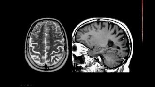 Atrofia cortical posterior [upl. by Ynatsyd18]