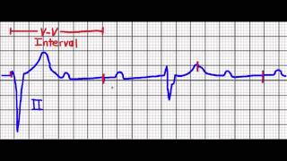 Cardiac Pacing Failure to CaptureFailure to Sense [upl. by Annadal]