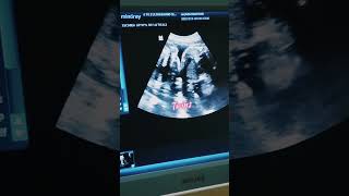 twins fetalheart usg abdomen baby pregnant baby doctor [upl. by Trautman118]