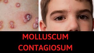 What is Molluscum Contagiosum Symptoms Treatment [upl. by Seigel]