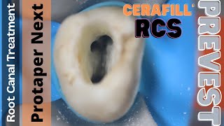 Root Canal Treatment in Maxillary Molar ⚪️ Protaper Next 🔵 Cerafill RCS Obturation [upl. by Lomax]