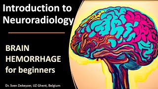 Imaging of Spontaneous Brain Hemorrhage the basics [upl. by Conni]