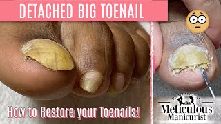 How To Pedicure Transformation for Men on Detached Toenails [upl. by Earla184]