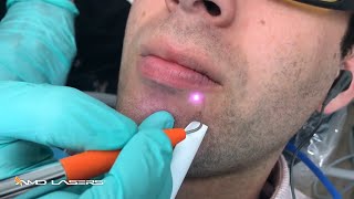 Herpetic Lesion Treatment [upl. by Hammond874]