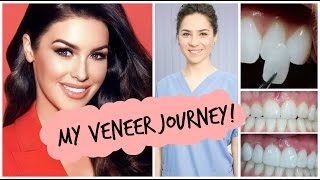 My Veneer Journey  Suzanne Jackson [upl. by Barty]