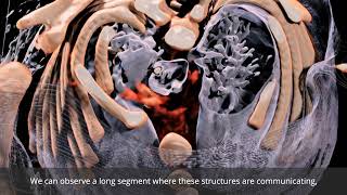 Anatomage Table Patient Case 302 Laryngotracheal Esophageal Cleft [upl. by Amasa]