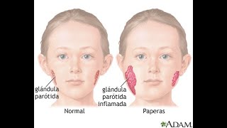 PAPERAS PAROTIDITIS CAUSAS SÍNTOMAS Y TRATAMIENTO [upl. by Svend297]