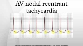 AV nodal reentrant tachycardia [upl. by Ardnek]