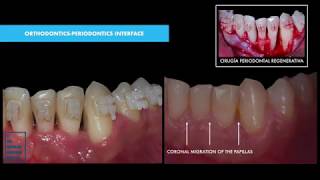 TRAILER GUIDED TISSUE REGENERATION WITH EMDOGAIN [upl. by Doowrehs638]