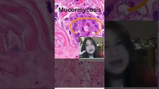 What does mucormycosis look like [upl. by Denman891]