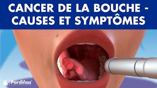 CANCER DE LA BOUCHE  Causes symptômes et types de tumeurs buccales © [upl. by Atinniuq488]