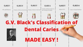 GV Blacks Classification of Dental Caries Quick and Complete Revision [upl. by Zicarelli]