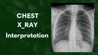 What is this called Chest X ray Interpretation 🤔anatomy youtube radiology [upl. by Mackie]