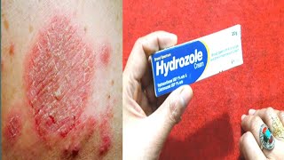 Hydrozole Cream Benefits And Uses Stop Skin itching Fungl  Khooni Kharish By Sanam [upl. by Verney573]