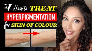 DOCTOR Vs HOW TO TREAT HYPERPIGMENTATION for SKIN OF COLOUR  BROWN DARK SKINCARE  DR V soc [upl. by Bat544]